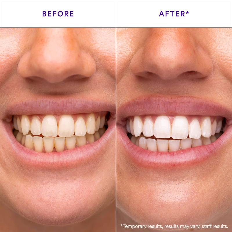 Whitenova™ Professional Teeth Whitening Strips – Whitening Without Sensitivity