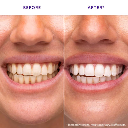 Whitenova™ Professional Teeth Whitening Strips – Whitening Without Sensitivity